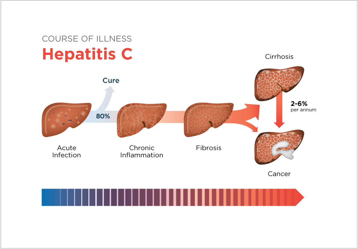 what is hepatitis c